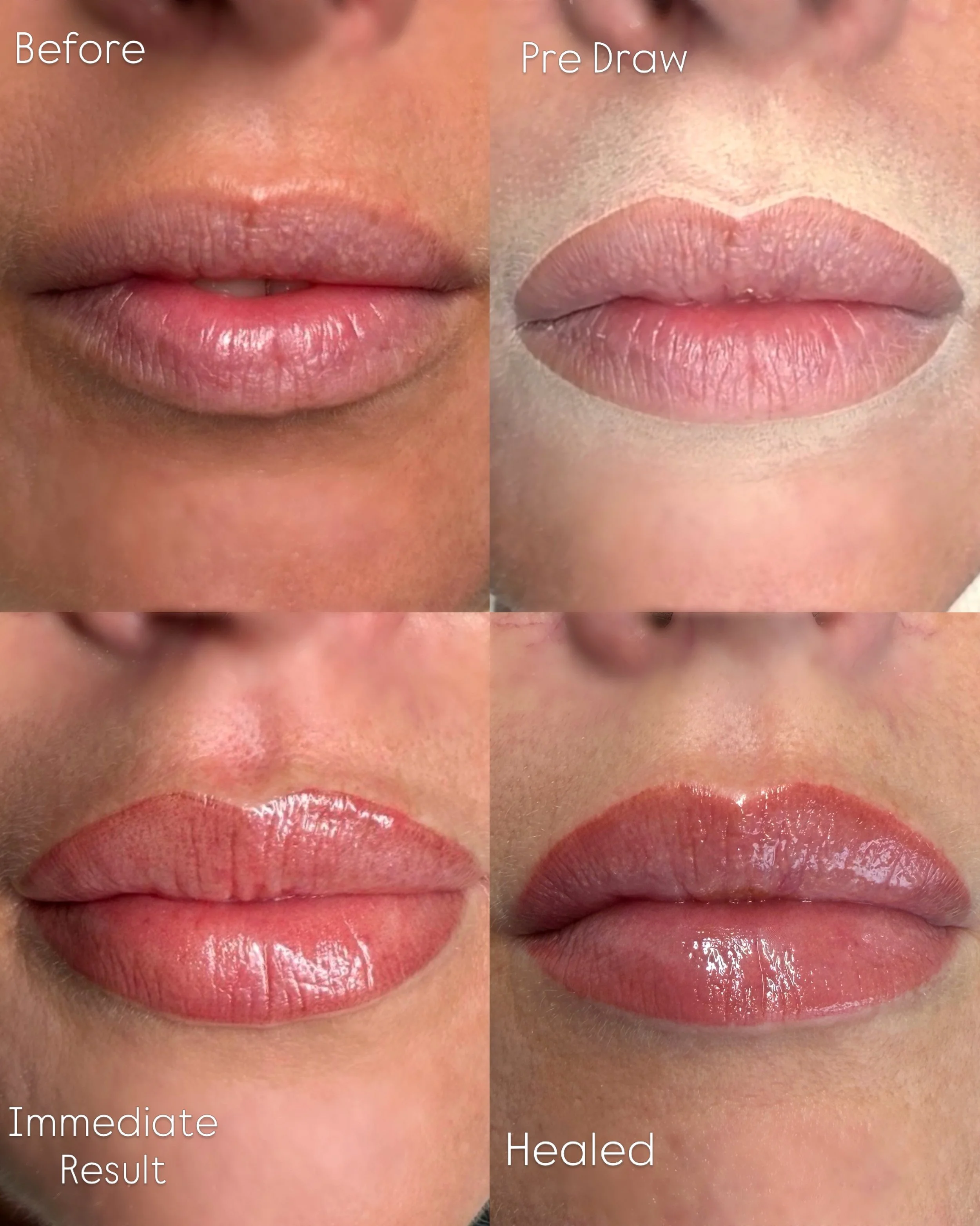 Progression of lip healing process, showing four stages: Before, Pre Draw, Immediate Result, and Healed, with close-up views of lips before and after a treatment.