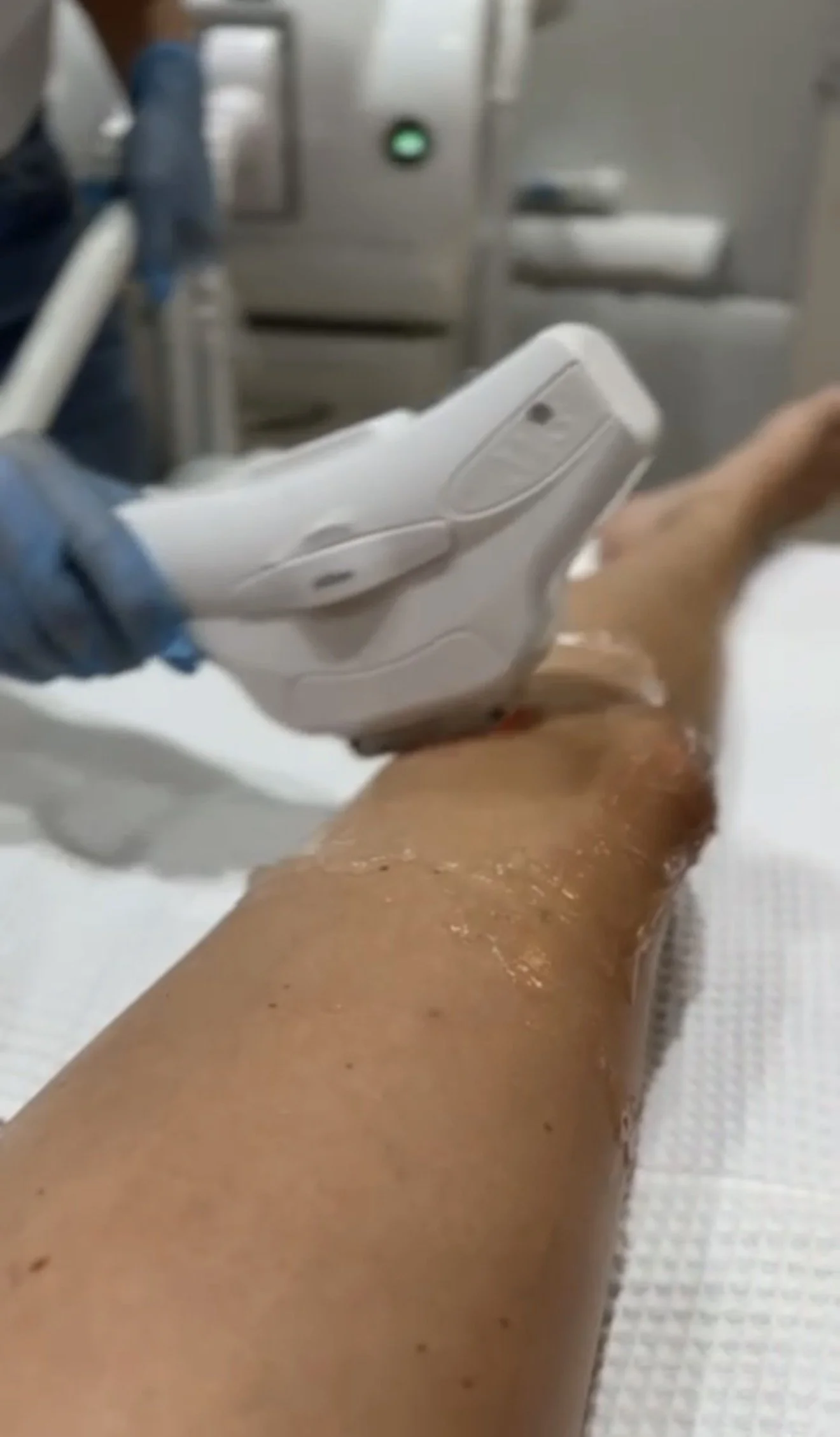 A healthcare professional using a handheld ultrasound device on a patient's arm in a medical setting.