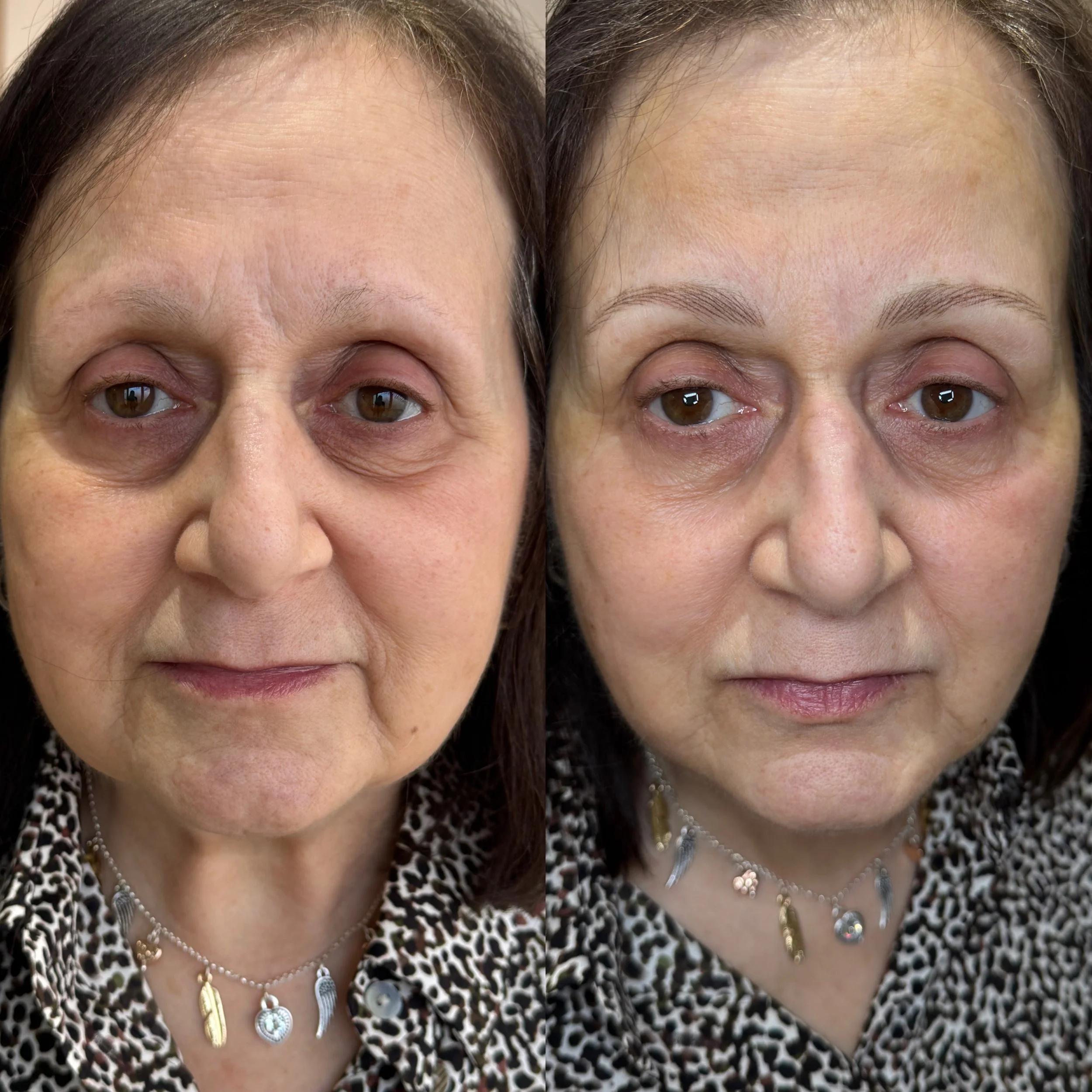 Side-by-side close-up images of a woman’s face showing before and after skincare or cosmetic treatment, with visible reduction in wrinkles and dark circles under her eyes.