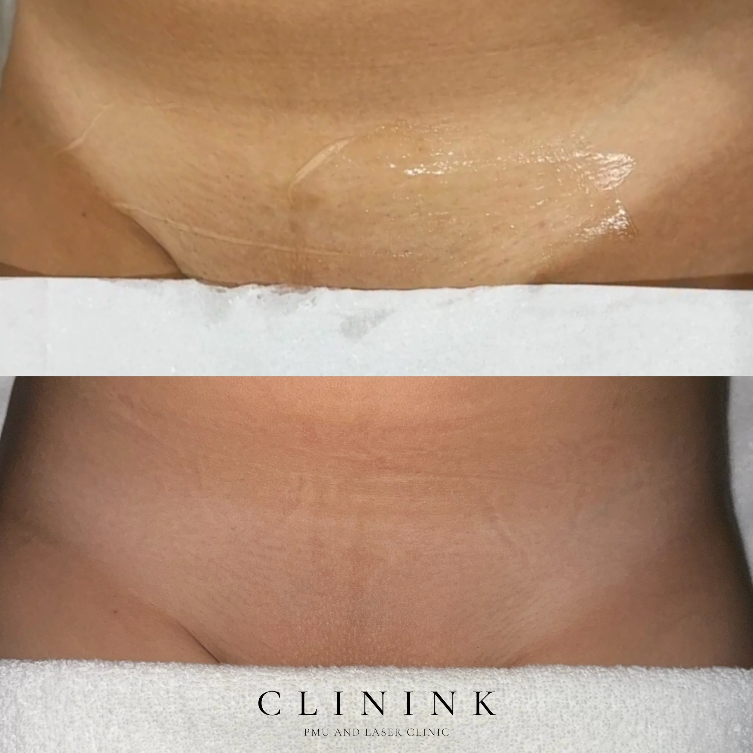Side-by-side comparison of a person's skin before and after a skin treatment, showing improvements in skin texture and appearance at the Clink PMU and Laser Clinic.