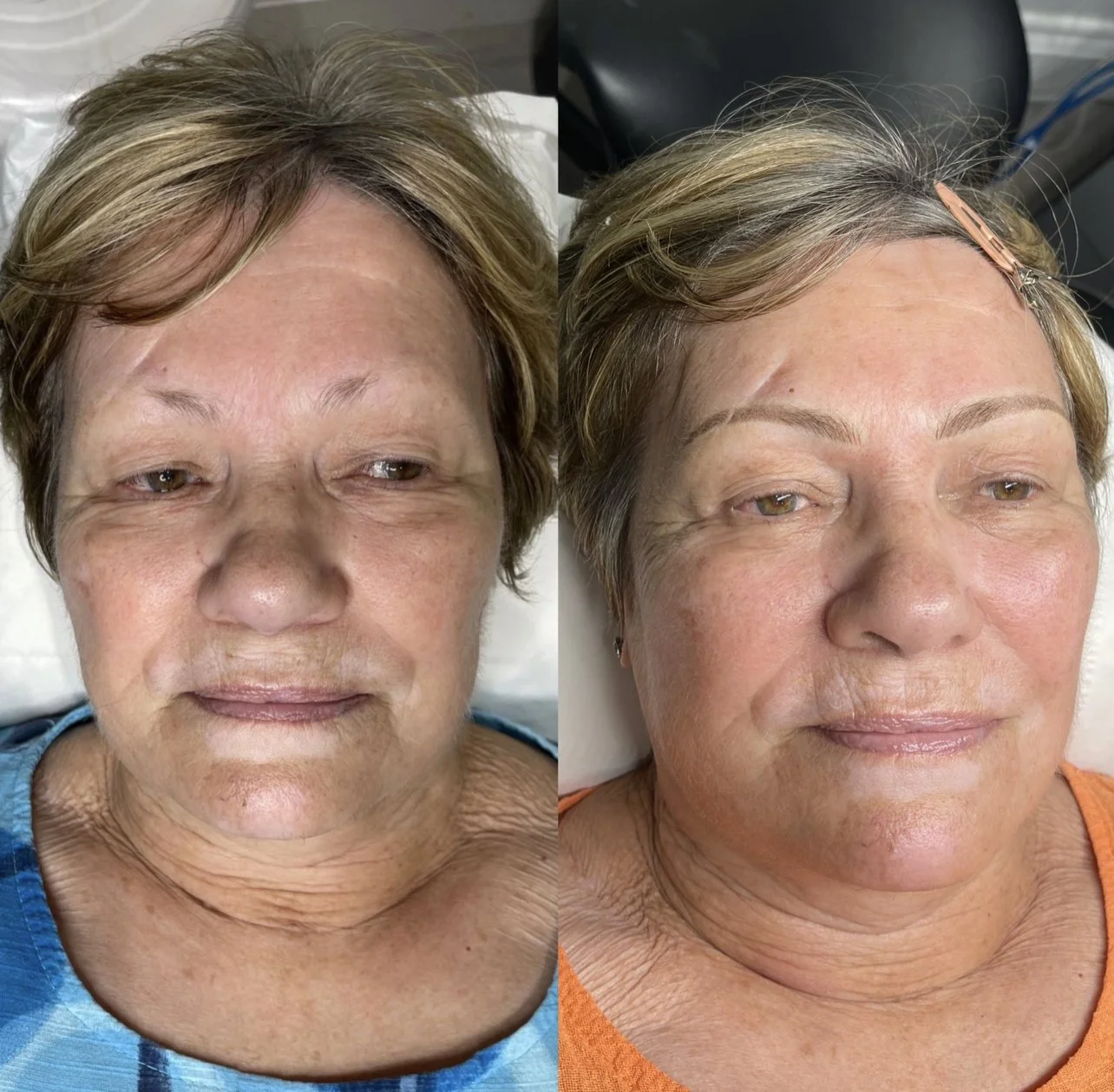 Comparison of a woman's face before and after a cosmetic procedure, showing improvement in skin texture and appearance.