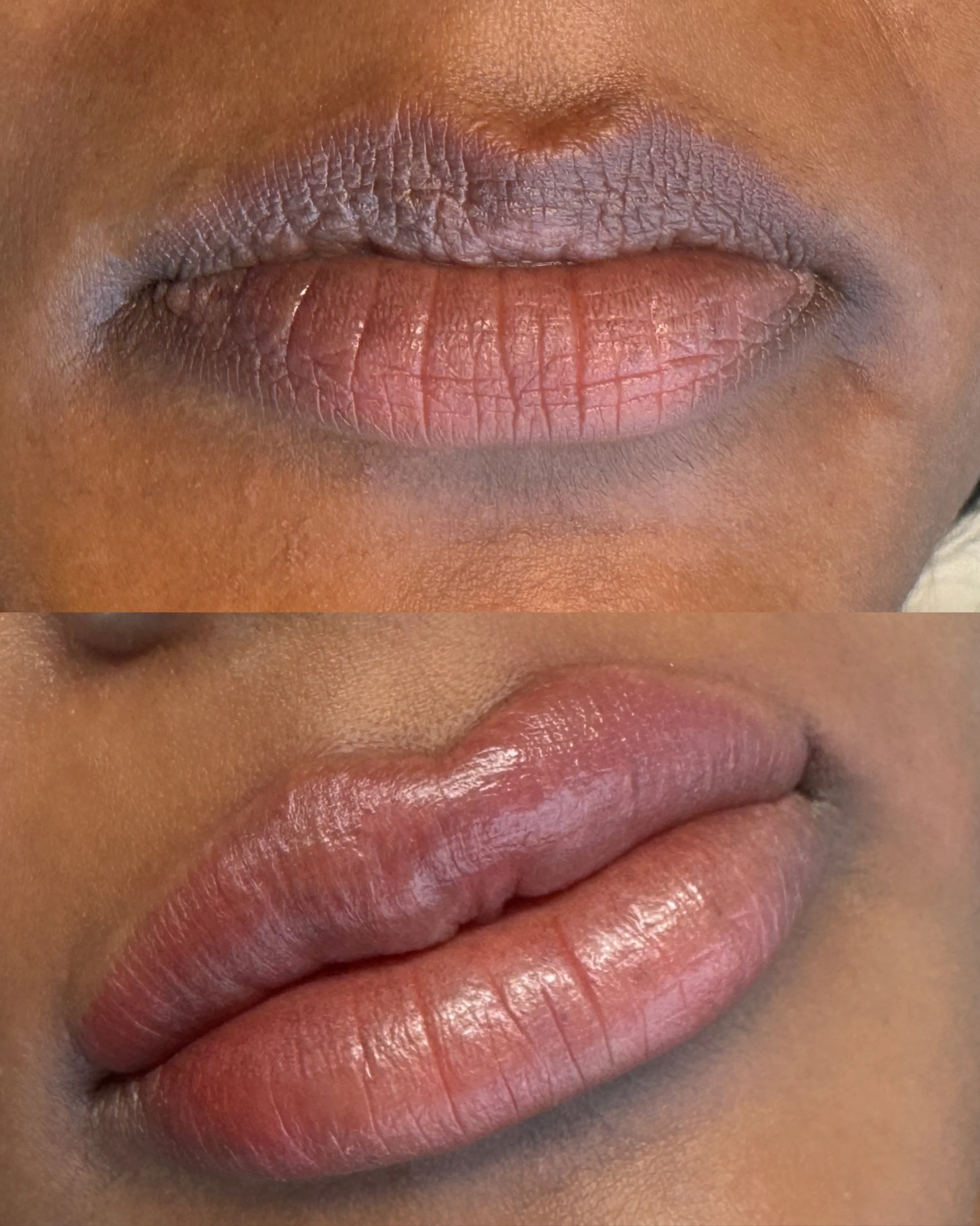 Close-up of a person's lips, showing before and after lip neutralising treatment, with visible texture and natural colour softened