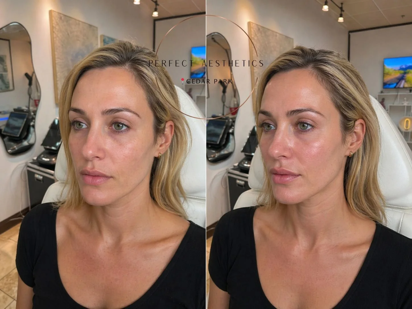 non-surgical-facelift-before-after-cedar-park.jpg.jpeg