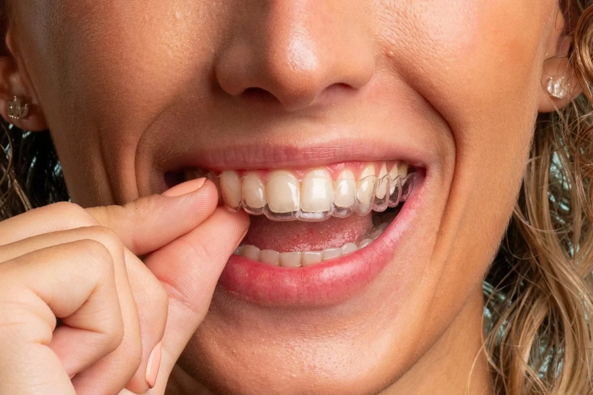 Retrato cercano de una mujer sonriendo, mostrando sus dientes con un aparato de ortodoncia transparente y pellizcando uno de sus dientes con la mano.