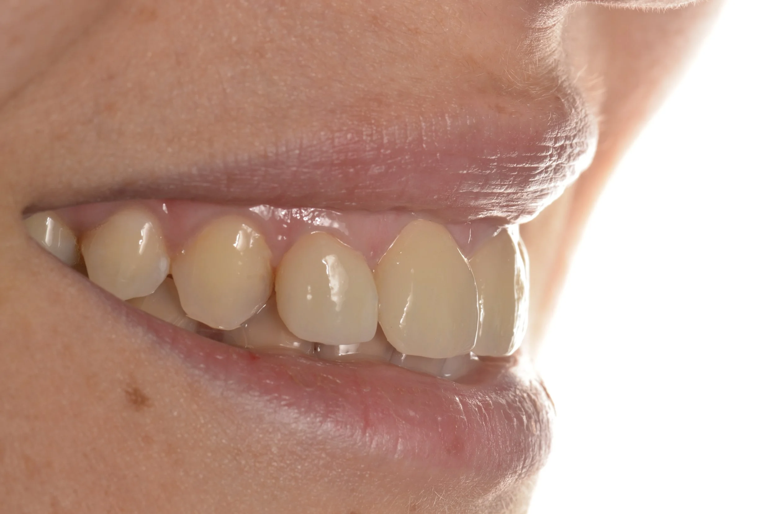 Sonrisa con dientes visibles, mostrando caries y daños en los dientes.