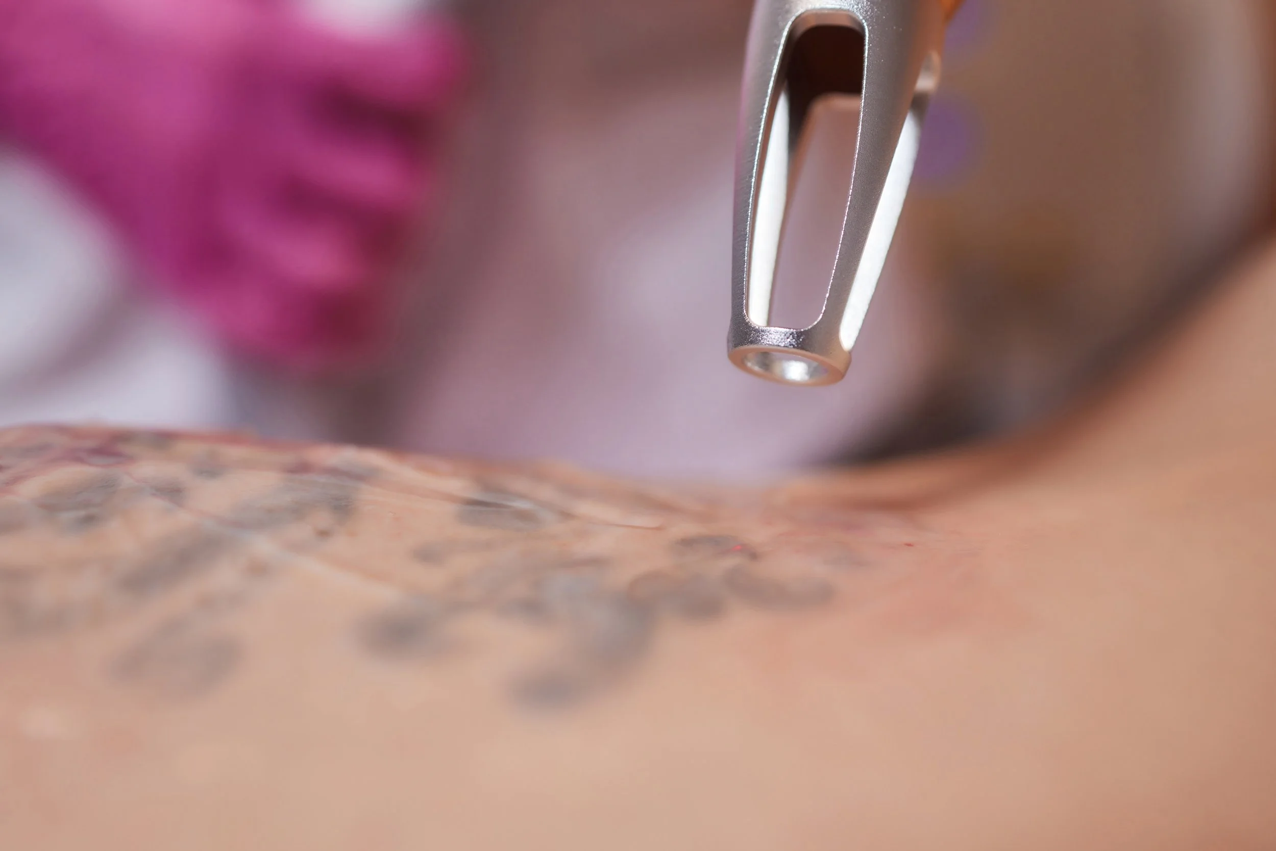 Tattoo Removal in Warrington: What You Need to Know Before Starting Treatment
