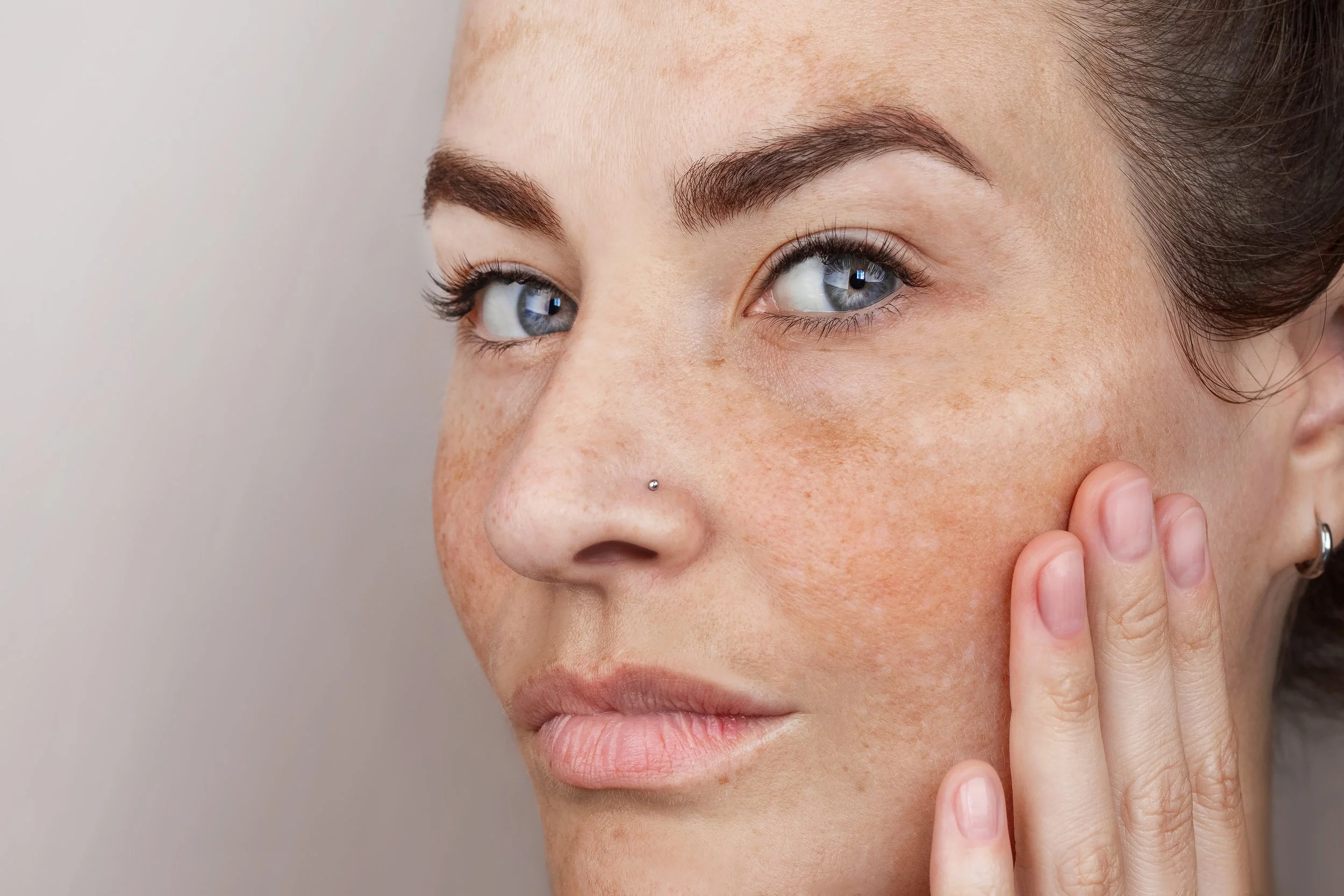 IPL for Pigmentation, Redness and Sun Damage: What Can It Actually Treat?