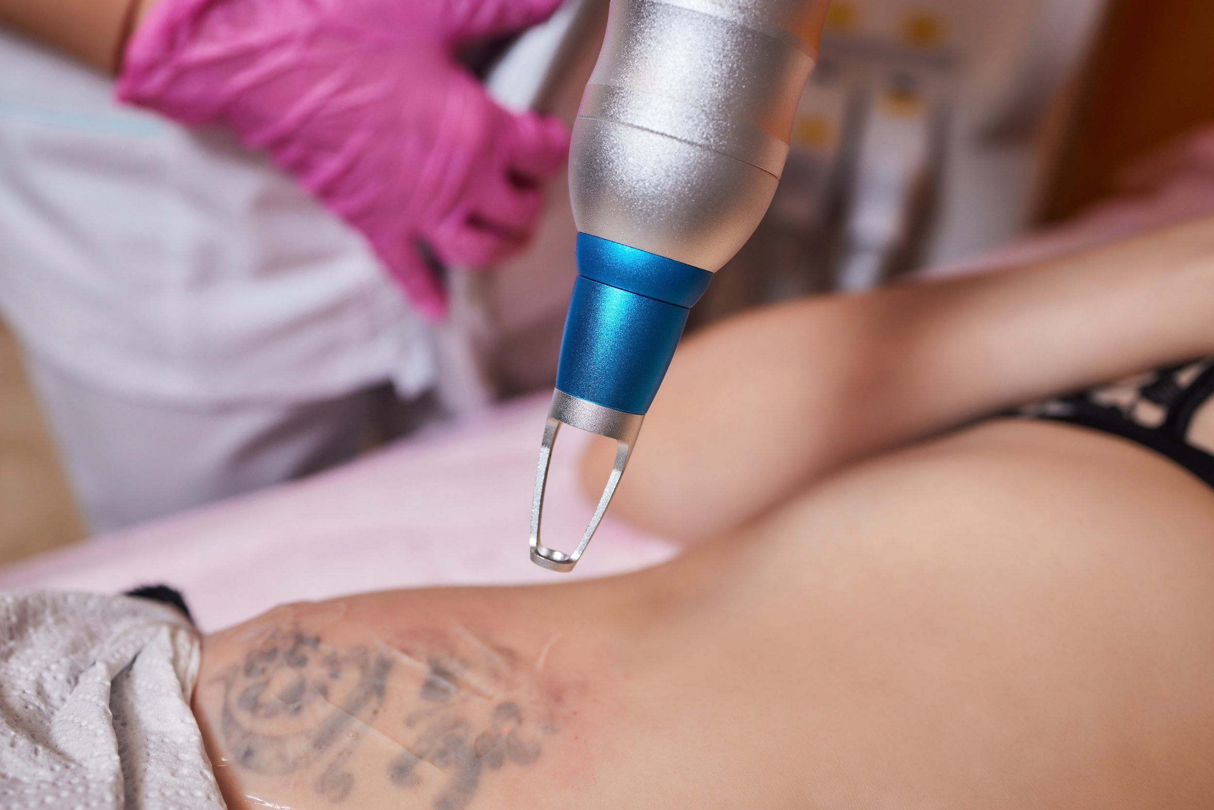 UltraLux Pro tattoo removal treatment in Warrington