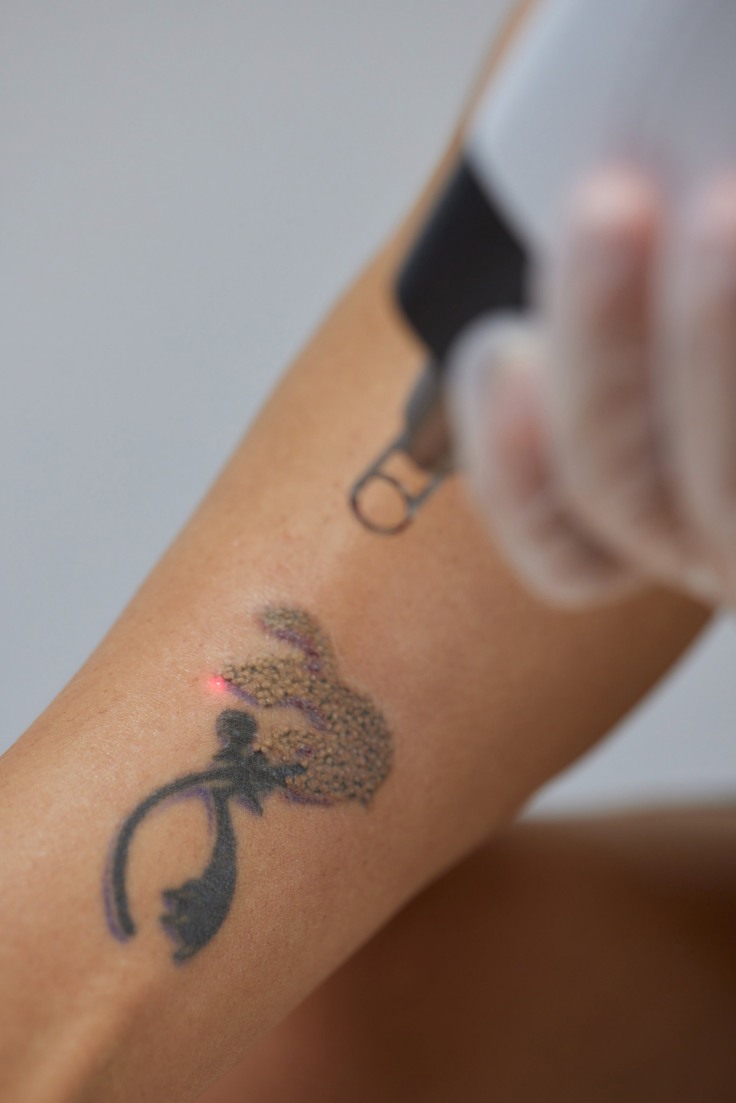 Laser tattoo removal at SkinFirst Warrington