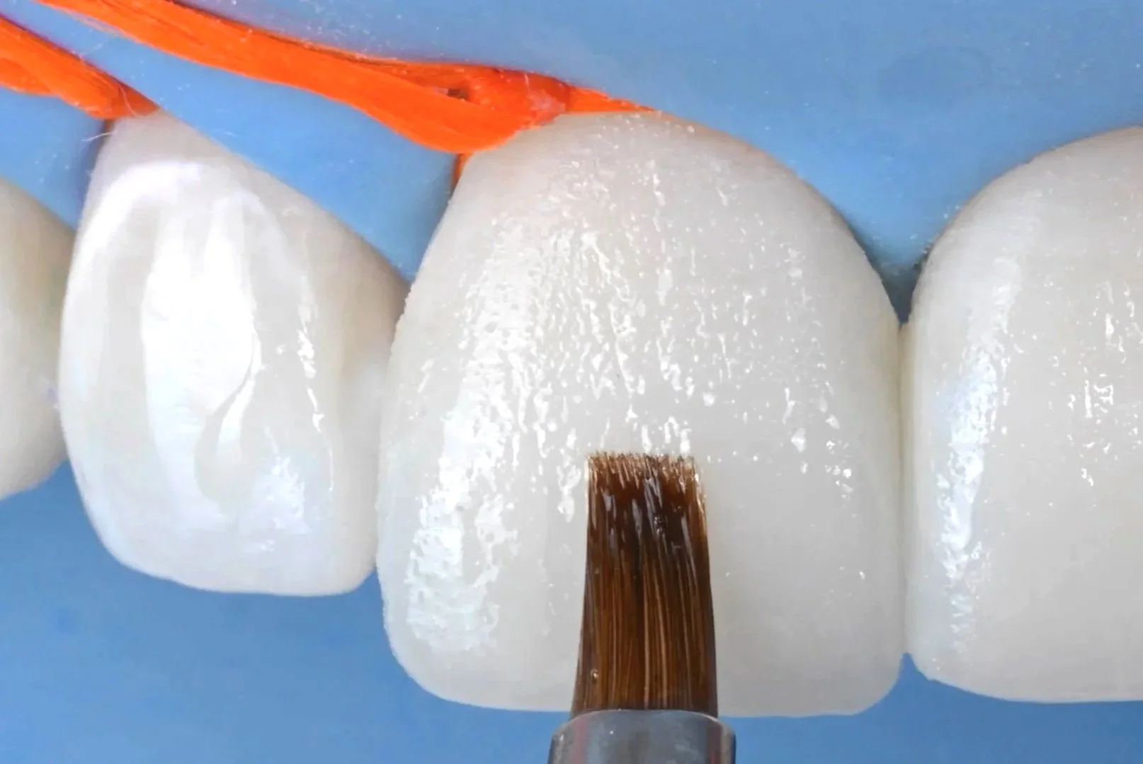 Close-up image of a composite bonding procedure with teeth, composite brush, rubber dam.