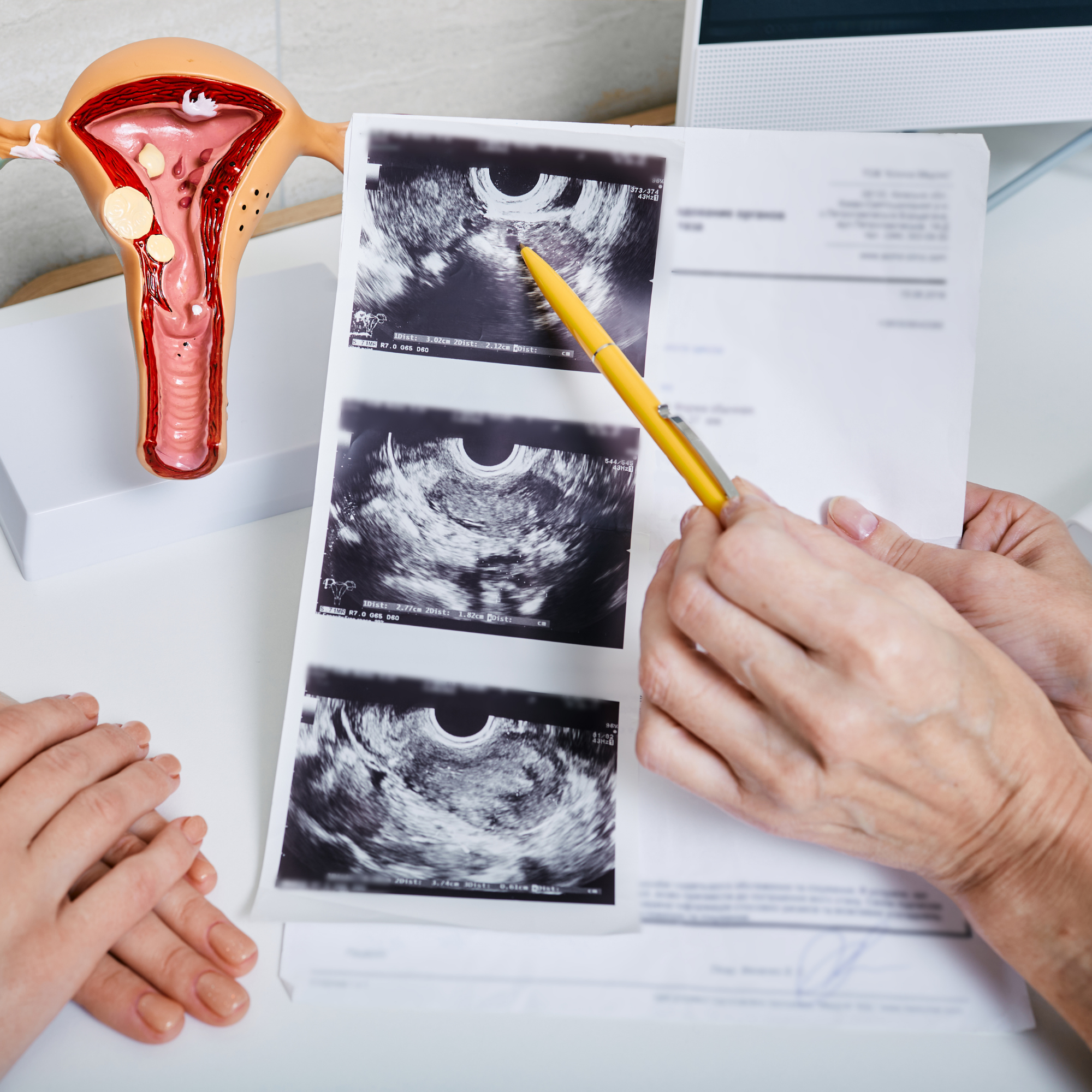 A medical model of a female reproductive system, a diagram showing the uterus, fallopian tubes, and ovaries, alongside an ultrasound scan and a hand holding a pen, all on a white surface in a clinical setting.