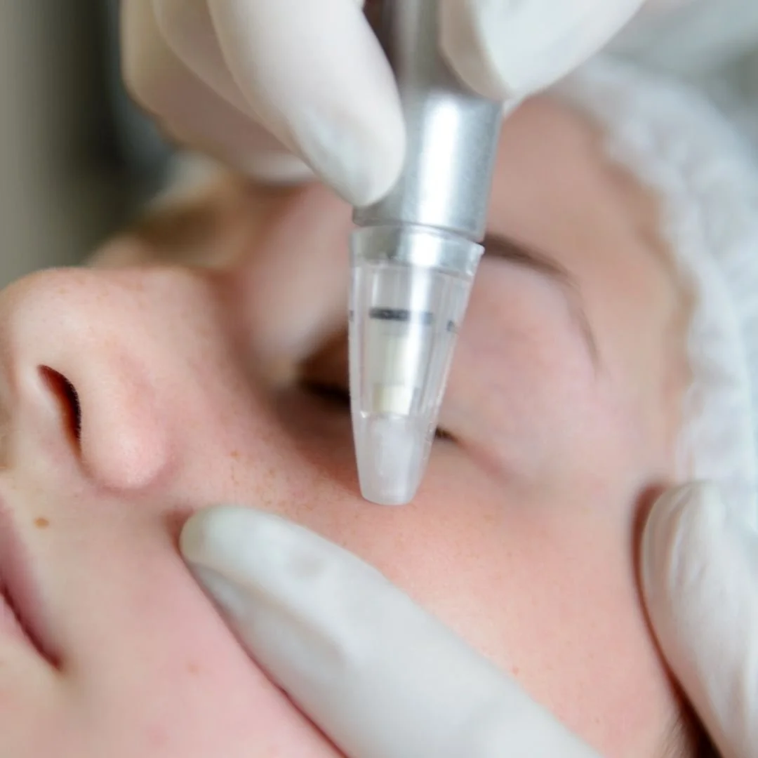 Microneedling (Price Varies)