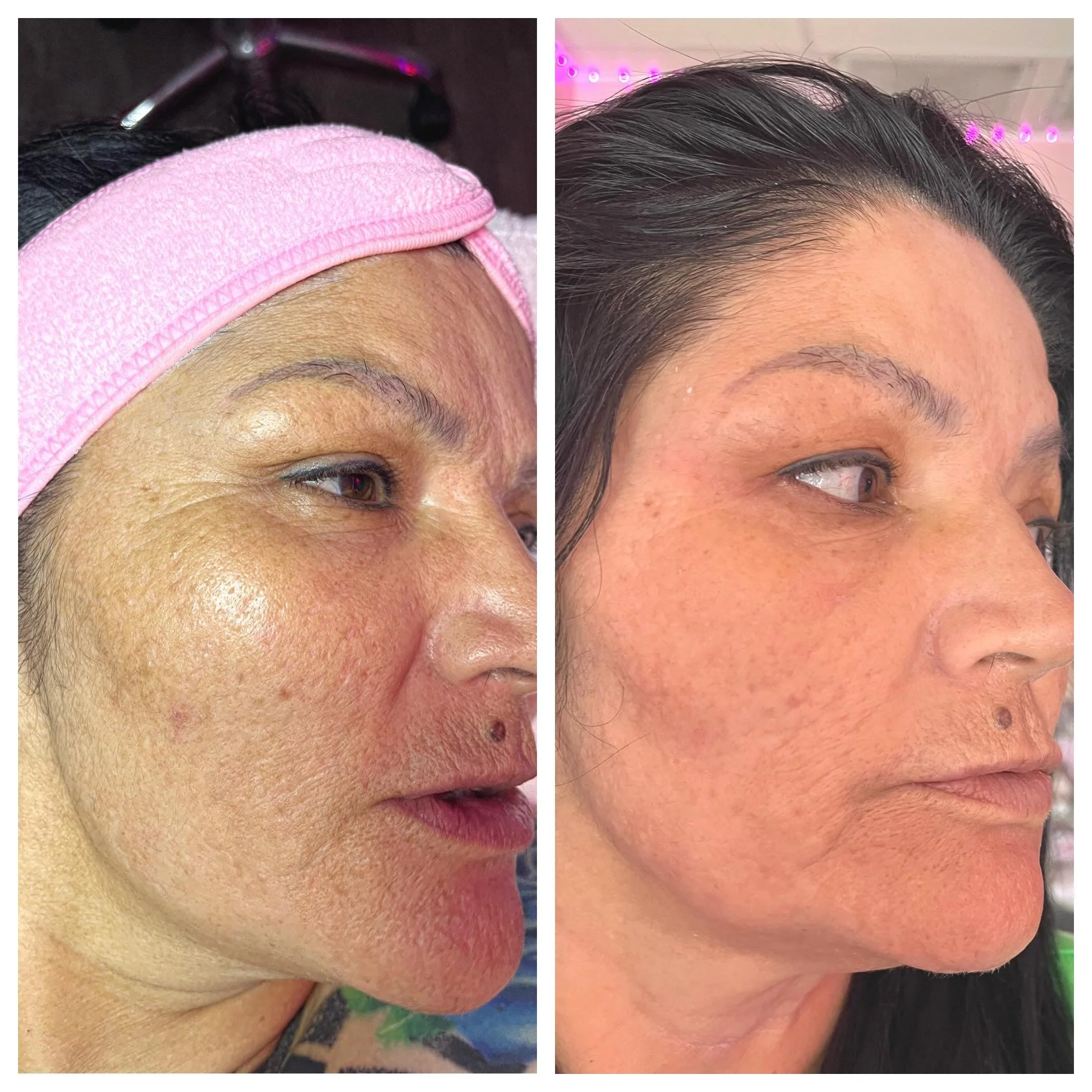 1 single treatment ALERT 🚨 This client wants to address past acne scarring, skin texture, and WRINKLES. Naturally I approached it with DMK&rsquo;s Alkaline wash and DMK Enzyme Therapy treatment. This is just 1 treatment. She is committed to do a ser