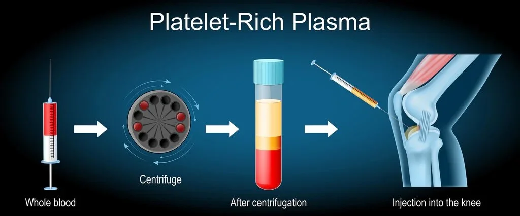 Diagram showing the process of creating platelet-rich plasma from whole blood, including centrifugation and injection into a knee joint.
