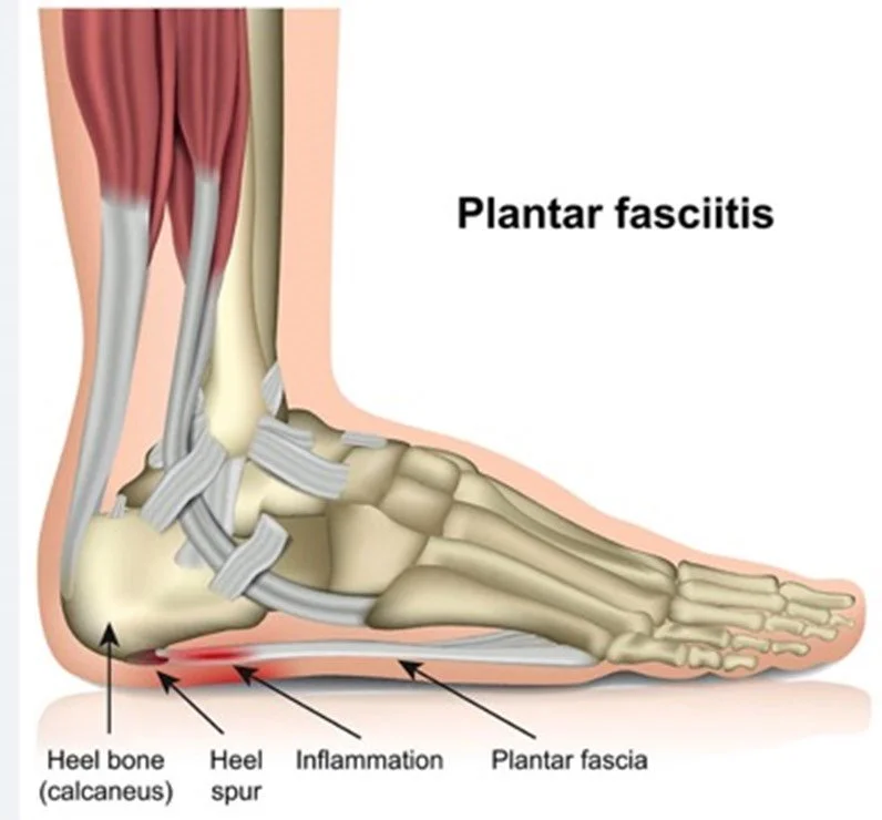 Diagram of a foot showing plantar fasciitis symptoms and anatomy, including heel bone, heel spur, inflammation, and plantar fascia.