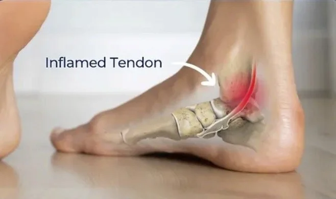 Diagram of an inflamed Achilles tendon with redness and swelling near the heel, labeled 'Inflamed Tendon'.