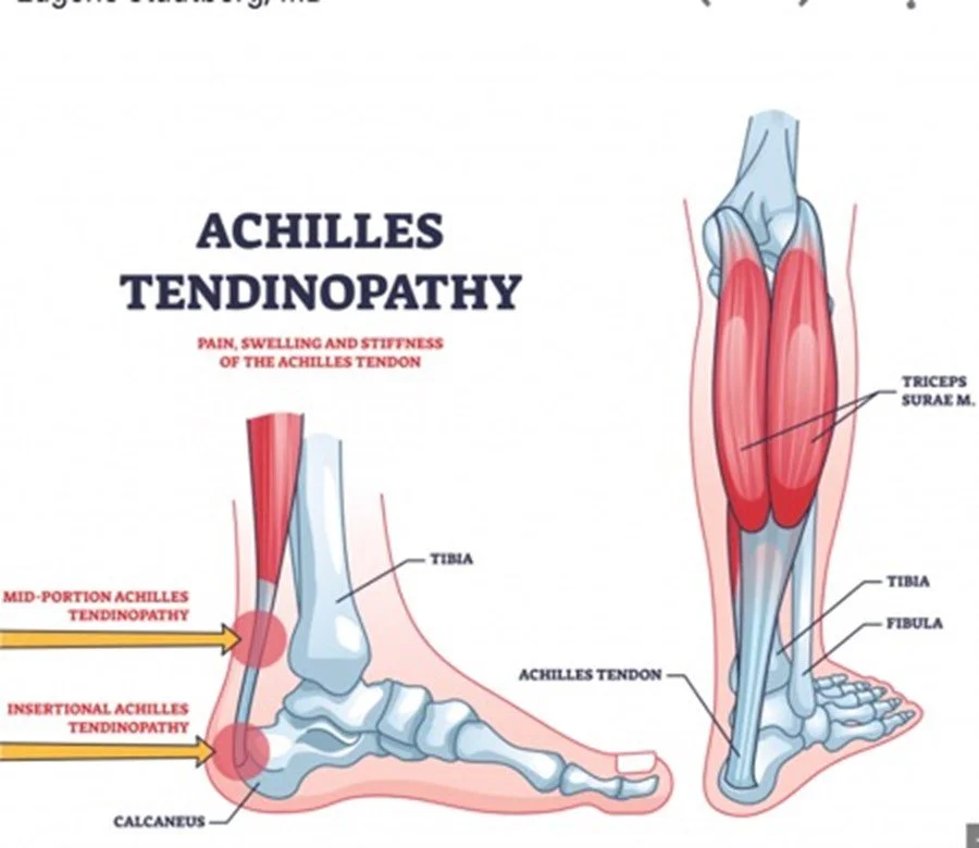 Diagram of Achilles tendinopathy showing inflammation, swelling, and stiffness of the Achilles tendon, with labels pointing to the mid-portion and insertional areas, along with bones like the tibia, fibula, and calcaneus.