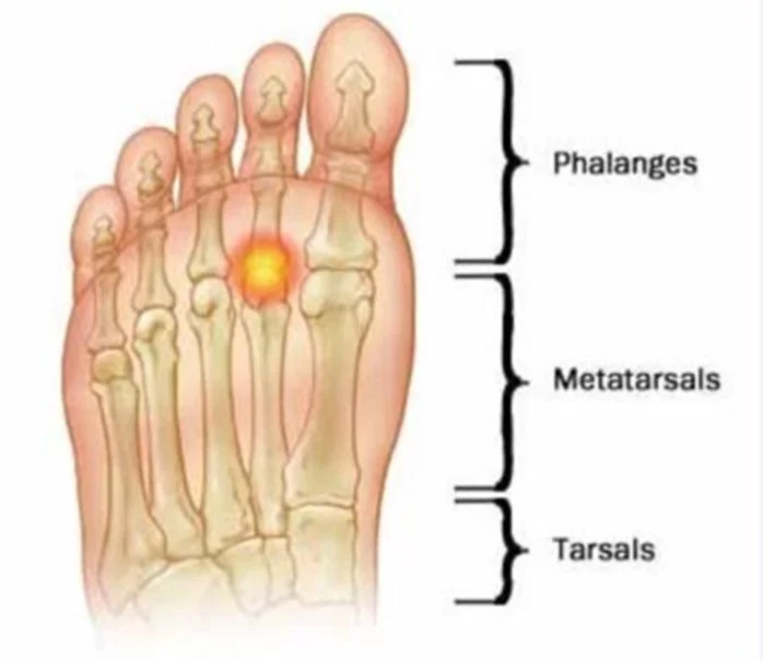 An illustration of a human foot showing the bones, with labels for phalanges, metatarsals, and tarsals. The middle of the foot is highlighted with a red glow.