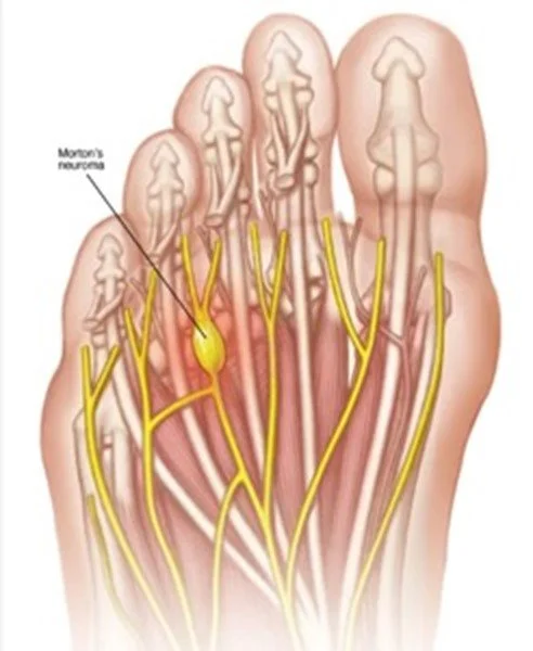 Diagram of the nerves in the foot showing Morton’s neuroma and the network of yellow nerves.