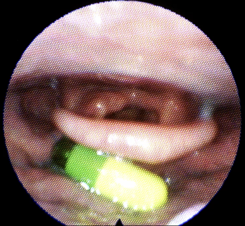 Close-up of a mouth with white teeth and pink lips, holding two pills, one green and one yellow.