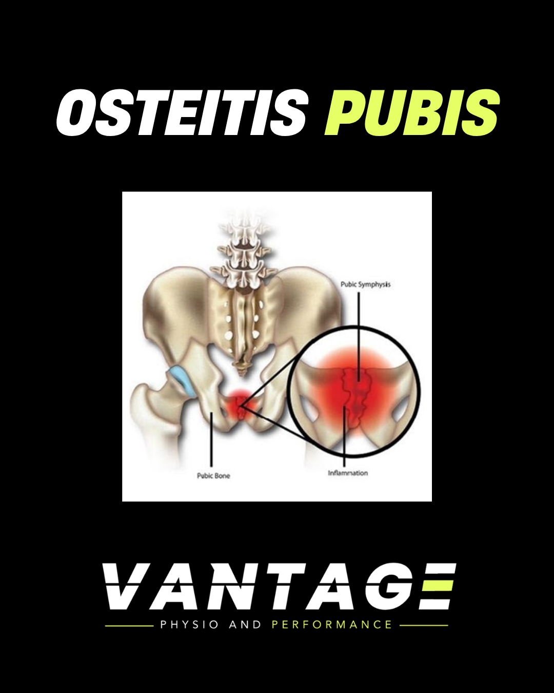 Osteitis Pubis: Recover and Return Strong