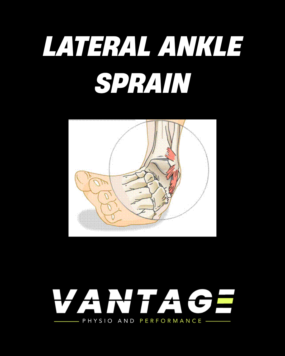 Lateral Ankle Sprains: Getting You Back on Your Feet