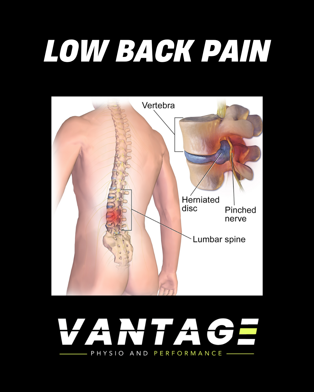 Low Back Pain: Understanding It and Getting Back to Doing What You Love