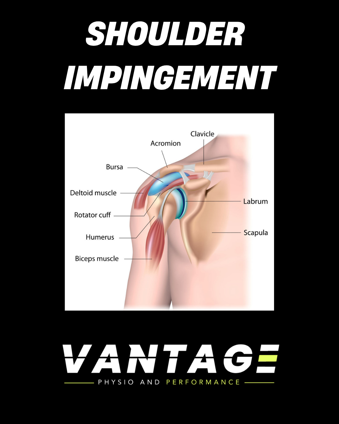 Shoulder Impingement and Sub-Acromial Bursitis