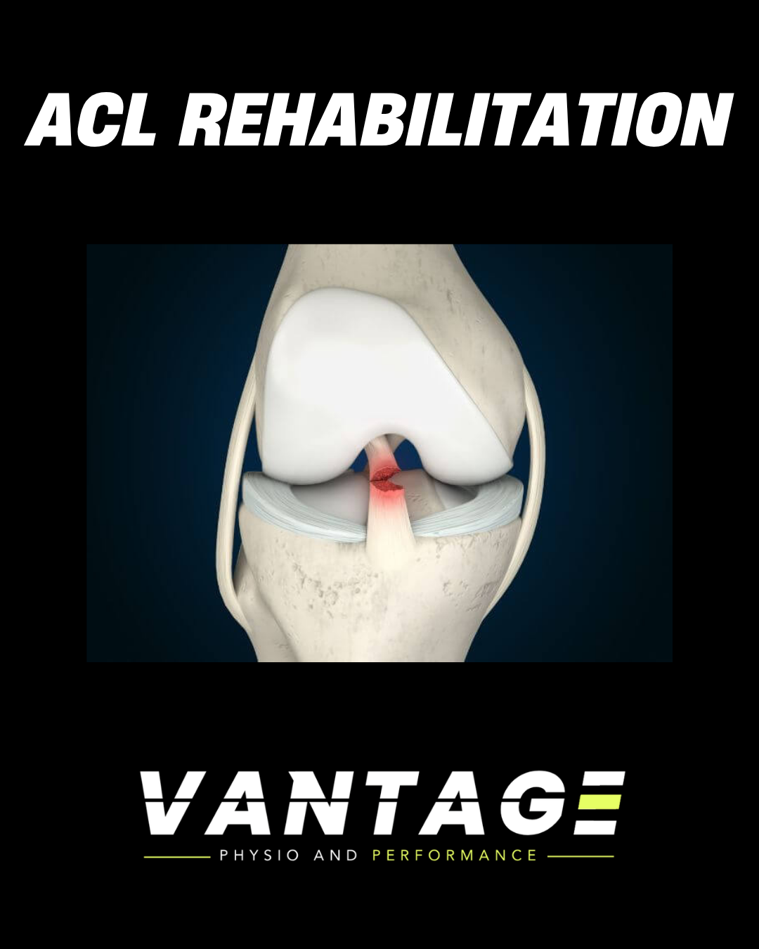 ACL Rehabilitation: Getting Back on the Field Stronger