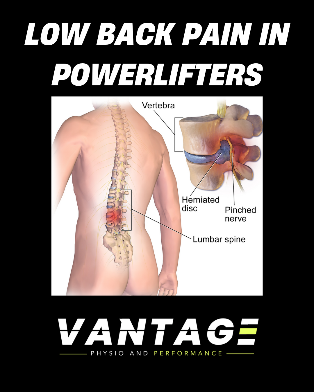 Discogenic Back Pain in Powerlifters: What You Need to Know, Why It Happens and How to Fix It