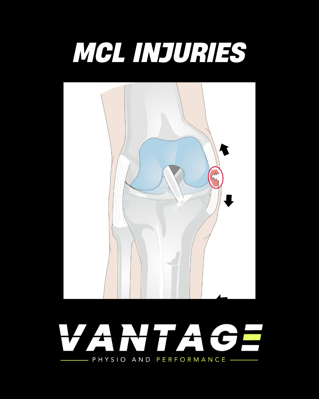 MCL Injuries: What They Are, How They Happen and How to Return to Sport Stronger