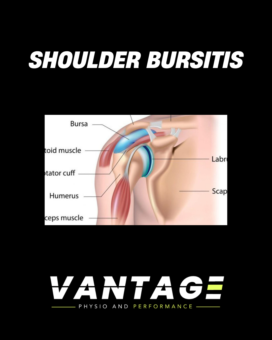 Shoulder Impingement in Powerlifters: Why It Happens and How to Train Through It