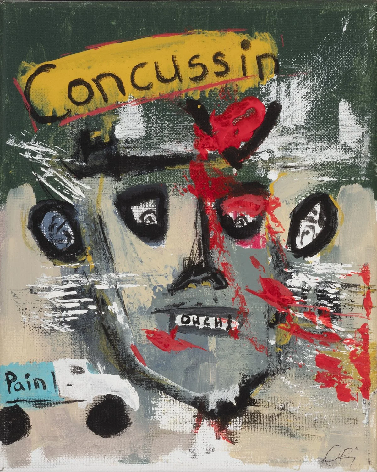 Concussin