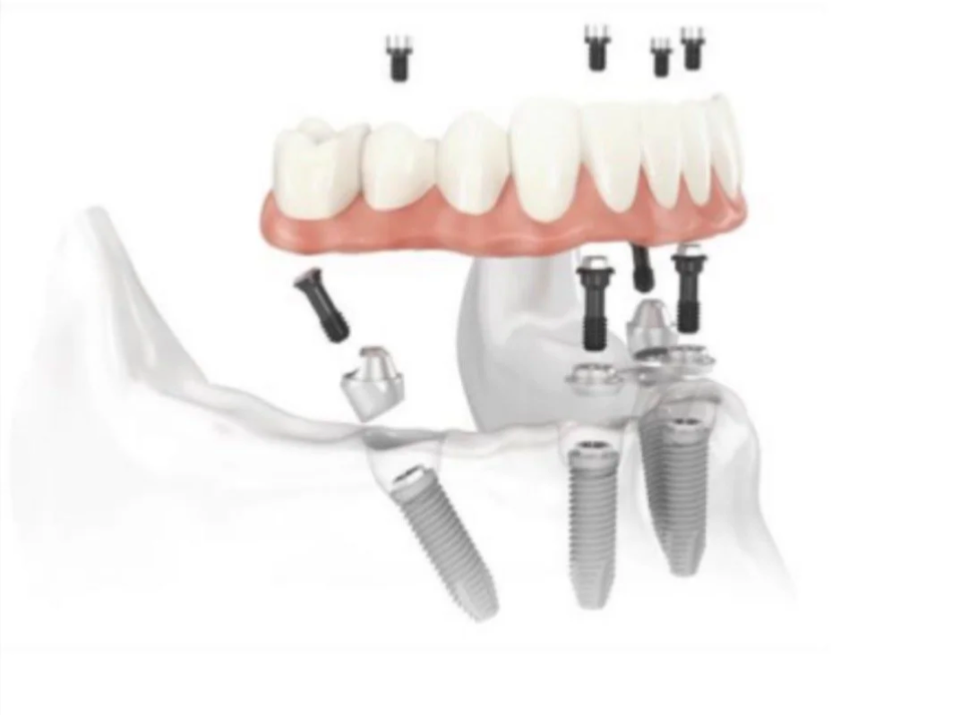 Diagram of a dental implant procedure showing artificial teeth, screws, and connectors in a dental arch.