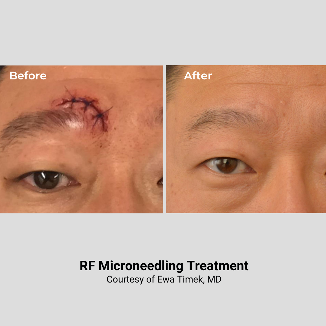 Before and after images showing the results of RF Microneedling treatment on an eye area, with a visible scar and stitches in the 'before' photo, and smooth skin with no visible scar in the 'after' photo.