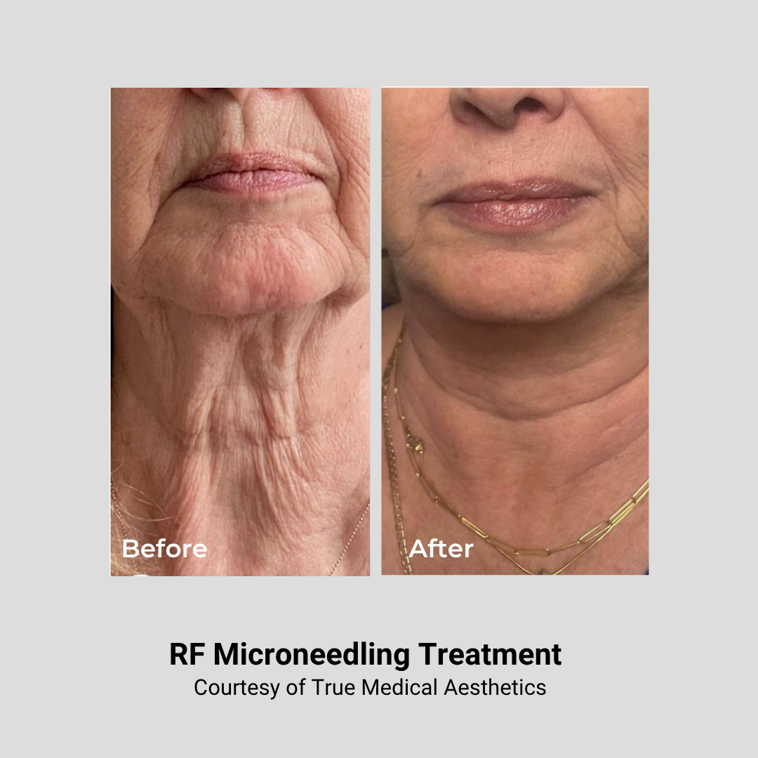 Comparison of an elderly woman's neck before and after RF microneedling treatment. The before image shows wrinkles and sagging skin, while the after image shows smoother, tighter skin with reduced wrinkles. Caption reads 'RF Microneedling Treatment, Courtesy of True Medical Aesthetics.'