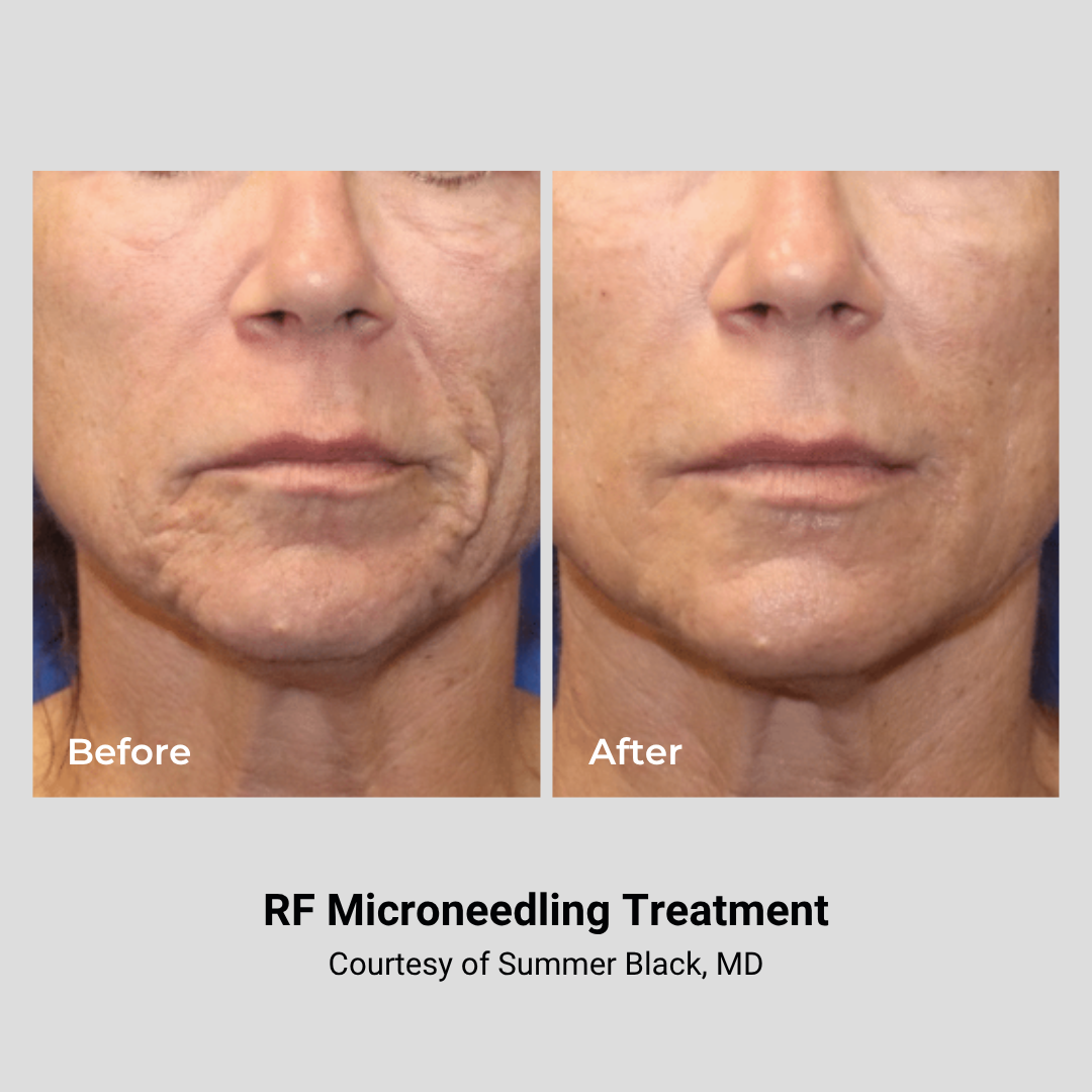 Side-by-side comparison of a woman's lower face showing before and after RF microneedling treatment, with visible skin improvement after treatment.