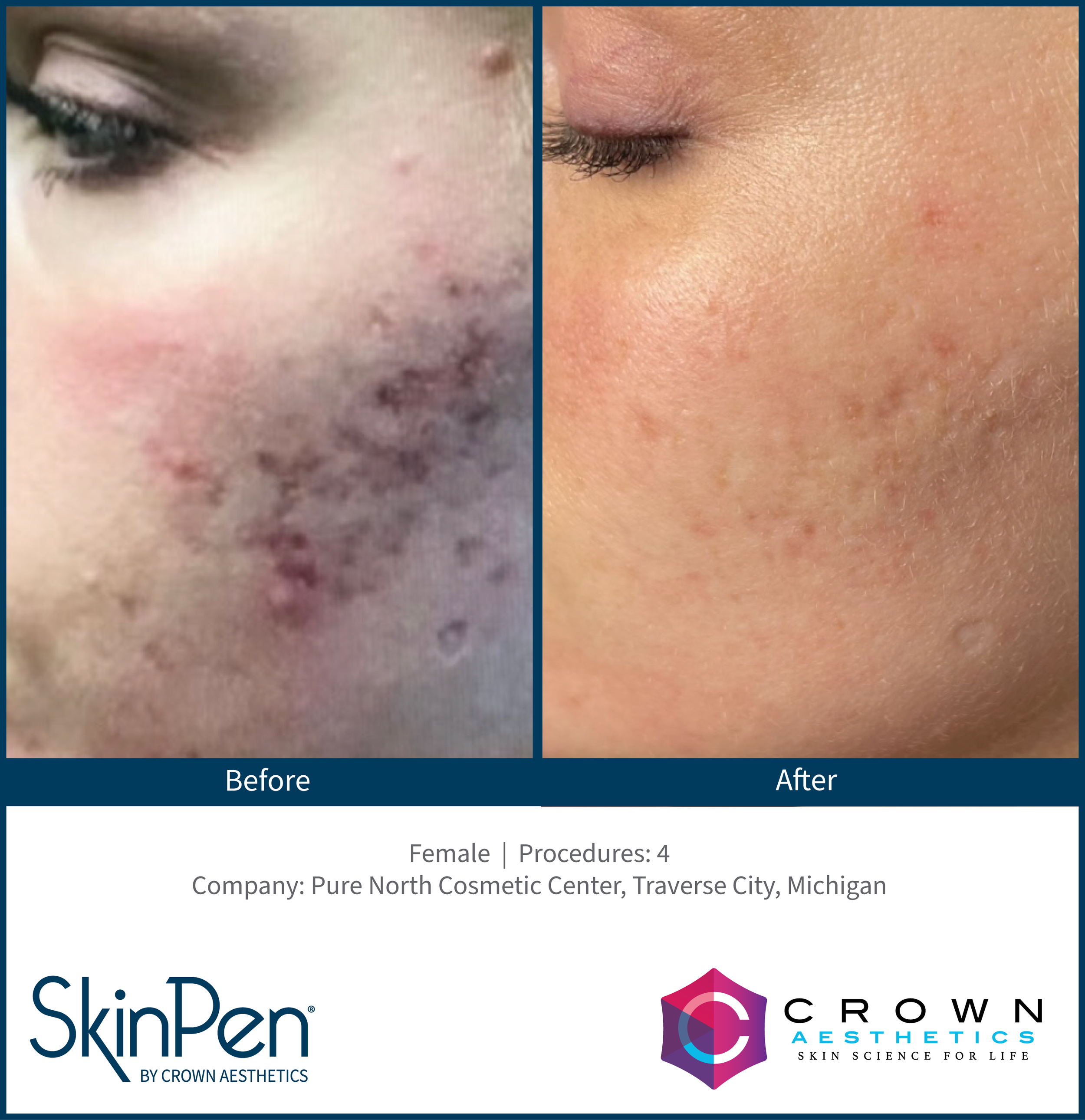 Comparison of dark, acne-prone skin before treatment and clear, smooth skin after treatment, showing a significant reduction in blemishes.