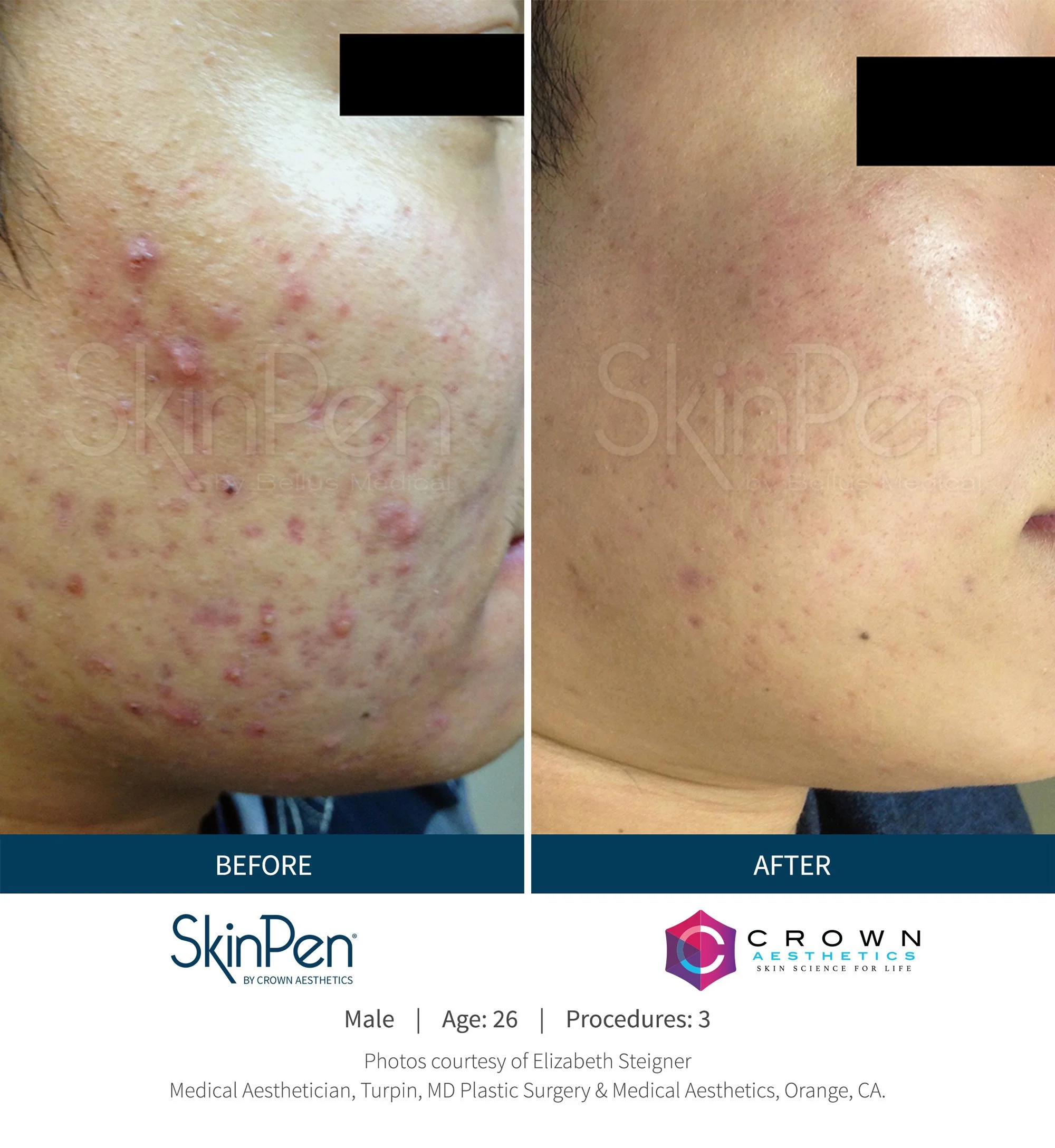 Close-up of a person's cheek showing a significant improvement in skin condition after treatment. The 'before' side displays numerous red pimples, pustules, and inflamed skin, while the 'after' side shows clear, smooth skin with no visible pimples or inflammation.