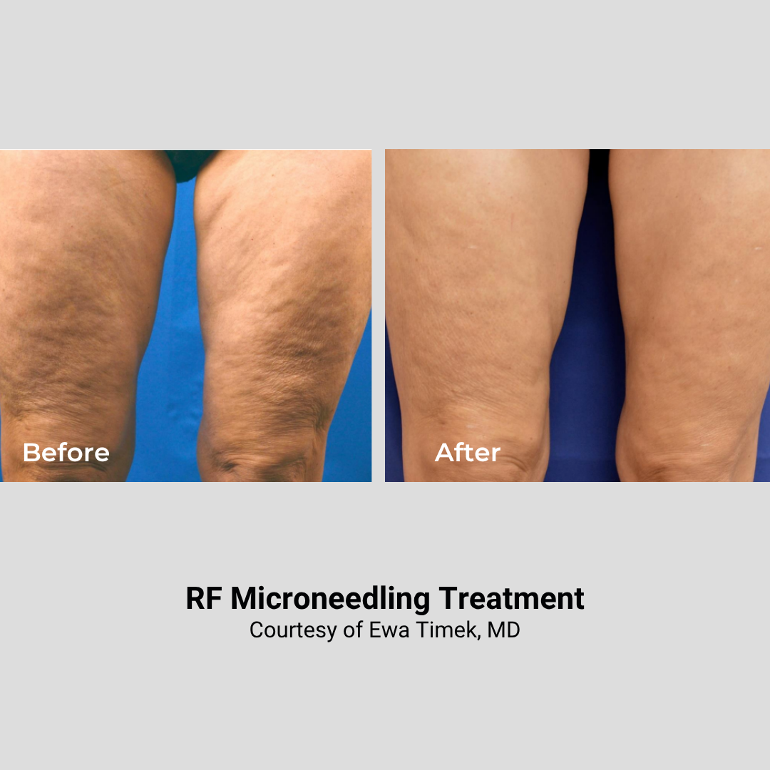 Comparison of thighs before and after RF microneedling treatment showing reduced skin texture and improved smoothness.