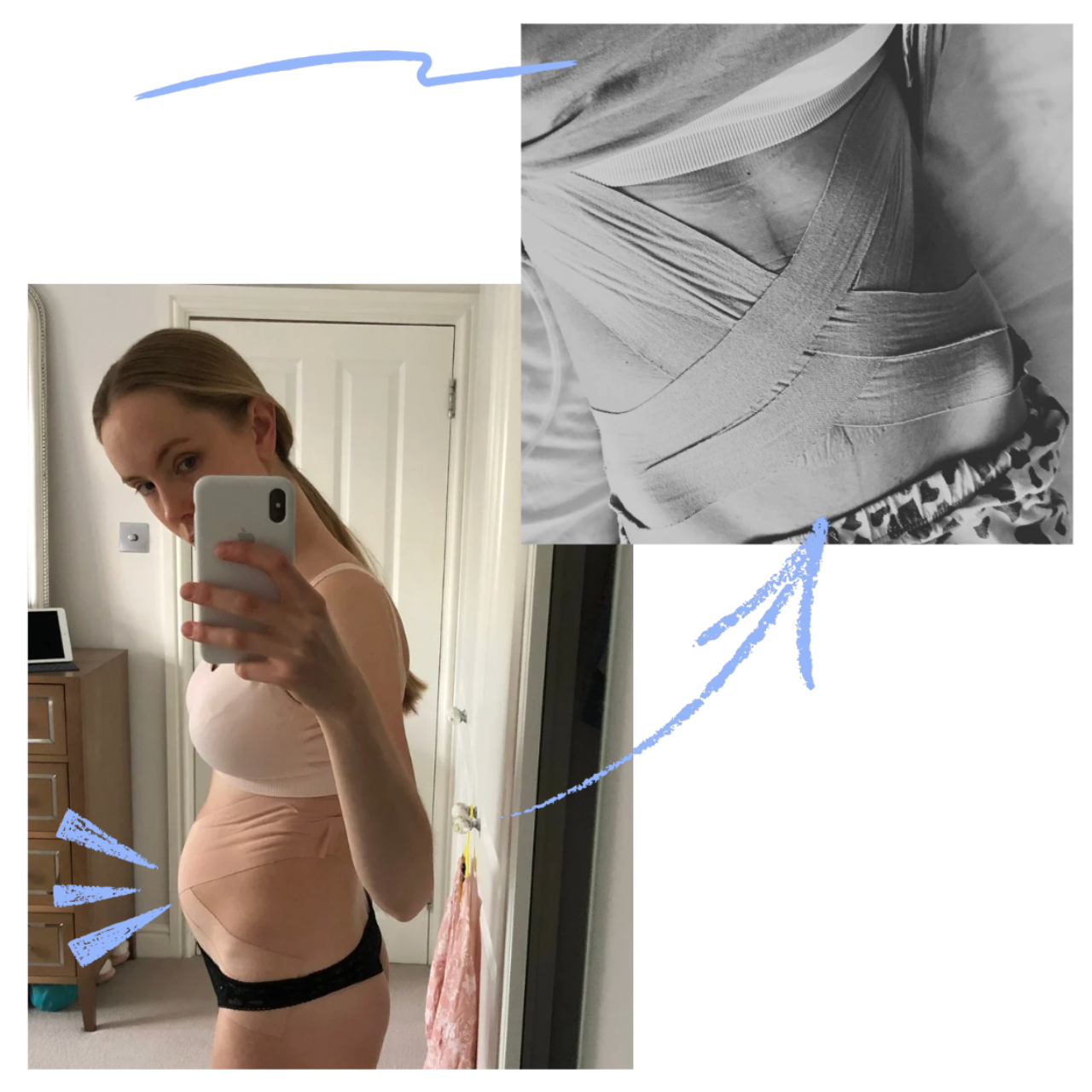 A pregnant woman taking a mirror selfie in a bedroom, wearing a beige maternity top and black underwear, with a close-up inset of her abdominal area wrapped in bandages.
