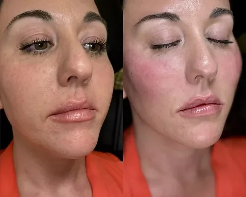 Close-up of a woman's face showing a before and after comparison of skin condition, with clear improvement in skin texture and reduction of dark spots.