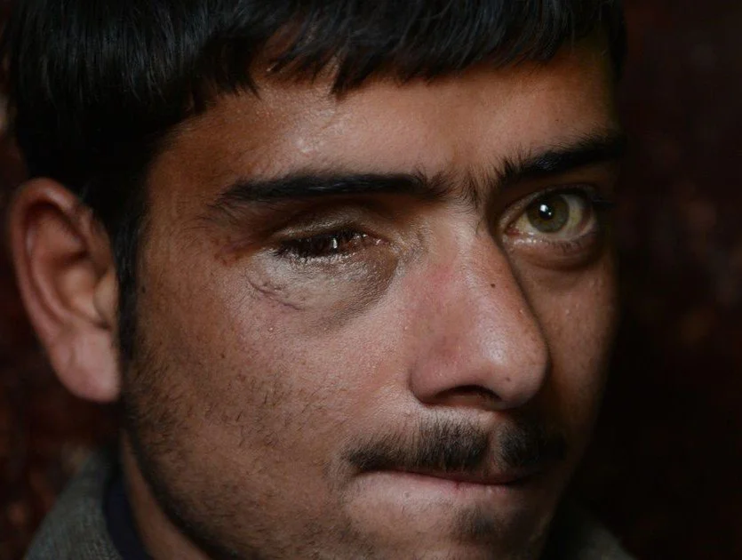 कश्मीर में अधिकांश पेलेट गन पीड़ित एक दशक बाद भी मुआवज़े के इंतज़ार में