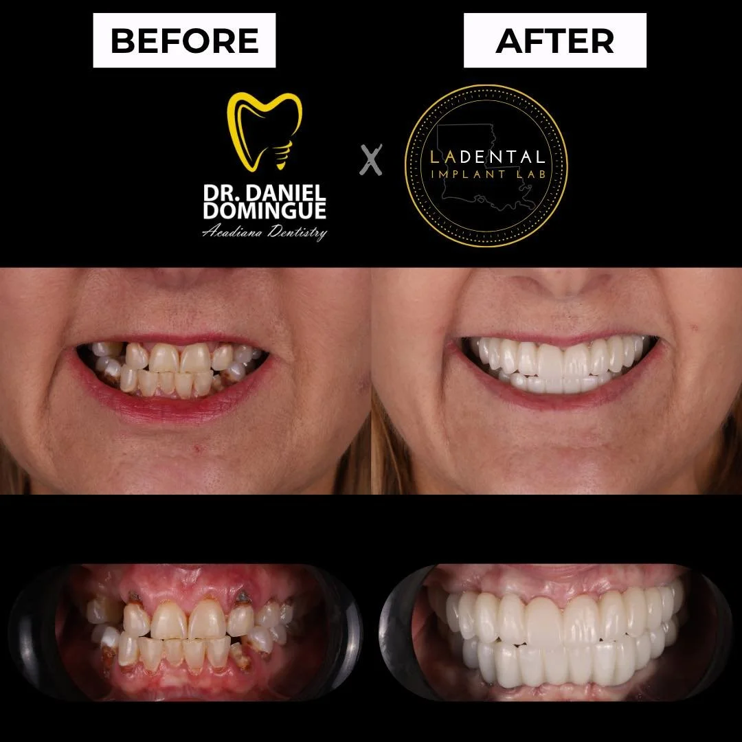 Severe generalized dental decay was present across the dentition, with clinical examination showing inflamed gingival tissue and seemingly intact occlusal surfaces. However, advanced imaging revealed extensive sub-surface decay and infection extendin