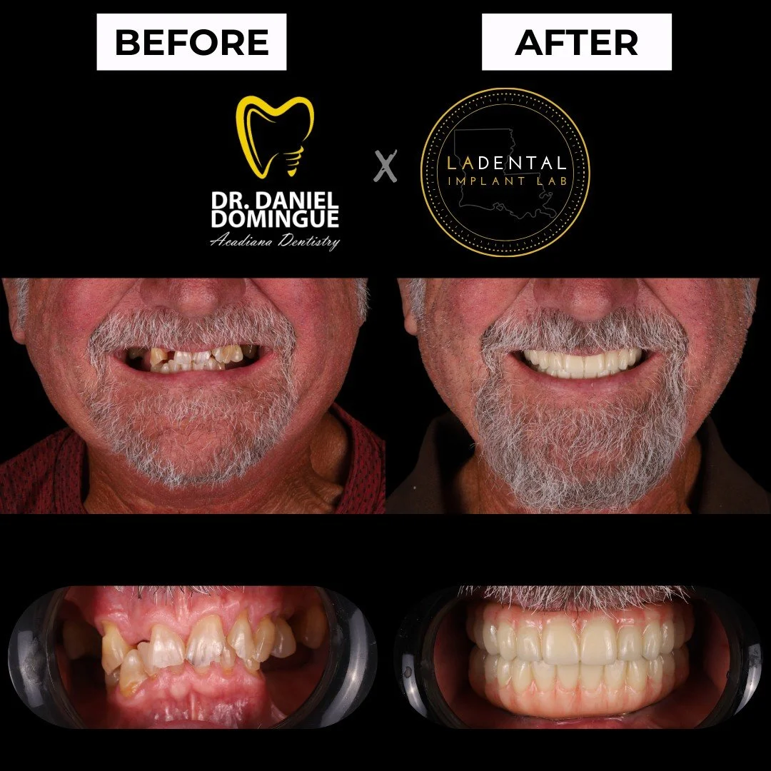 Severe wear, structural breakdown, and loss of posterior support had left this patient with a collapsed bite and compromised function. The upper dentition presented with extremely thin, chipped incisal edges and was no longer restorable. While some l