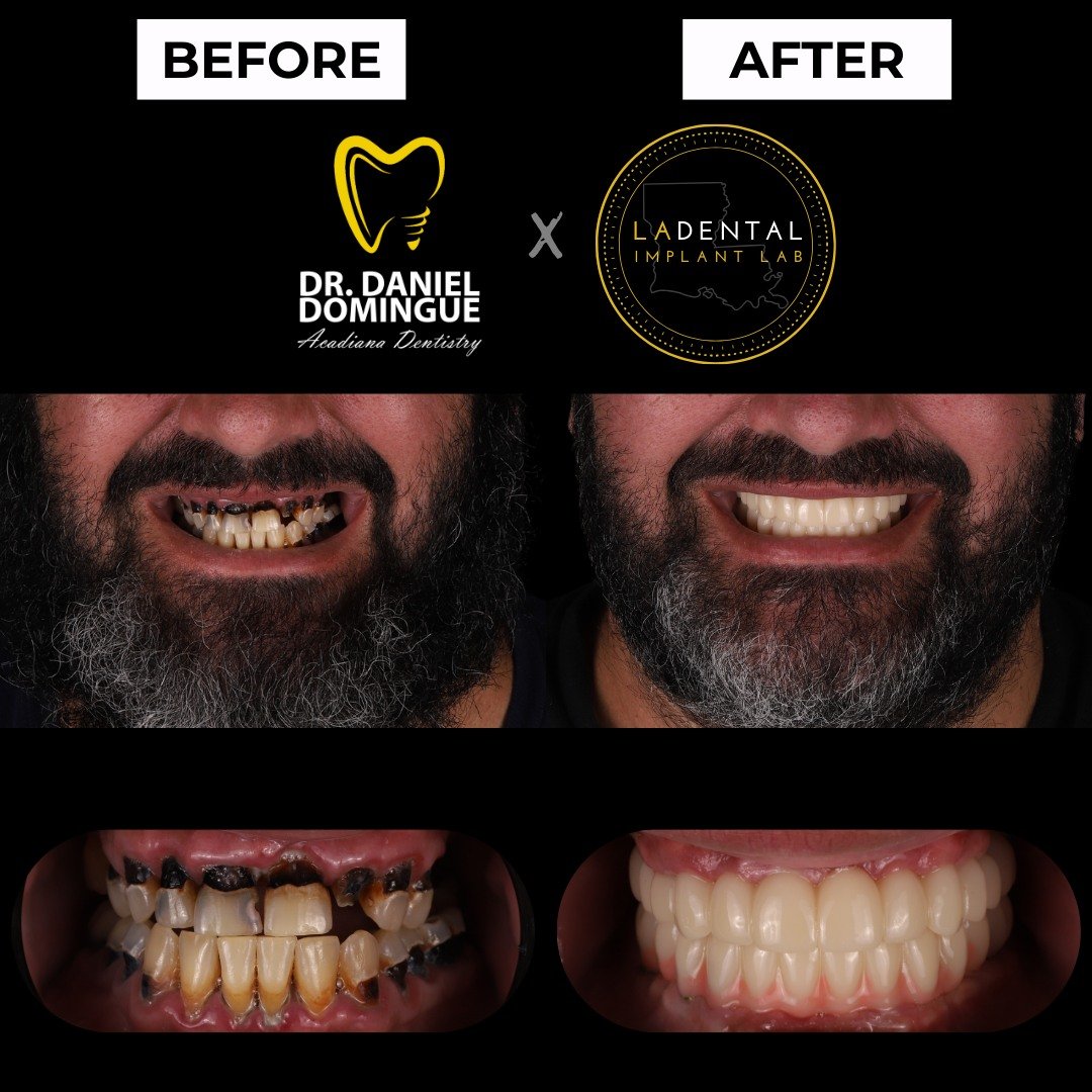 This patient first came to us in significant pain, with swelling on the lower left side and multiple areas of advanced decay. After a thorough examination and getting him comfortable with antibiotics and initial treatment, we discussed the long-term 