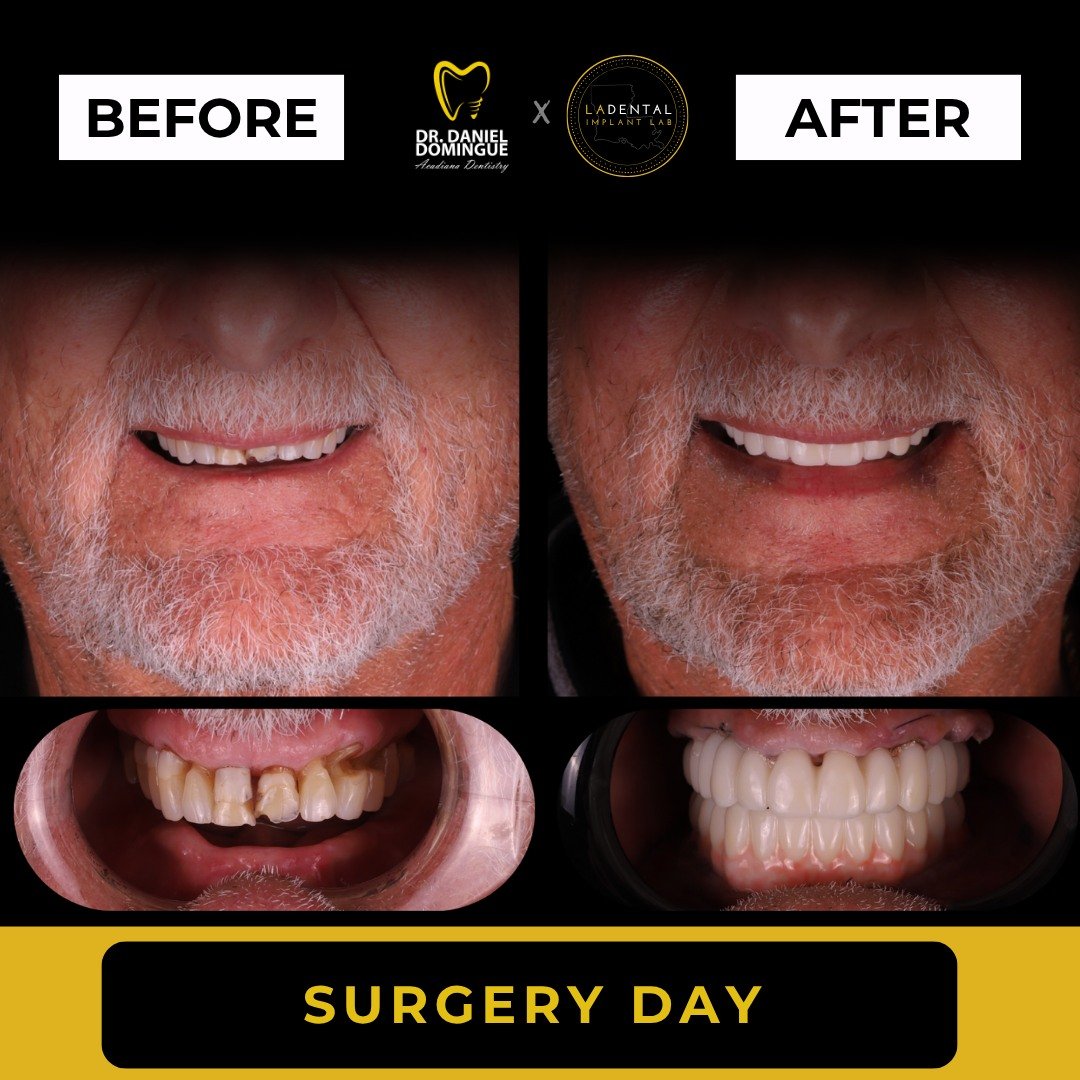 What a difference 24 hours can make.

This patient presented missing his entire lower dentition and relying on a removable denture, along with extensive structural damage to the remaining upper teeth. Nearly every tooth exhibited complications that m