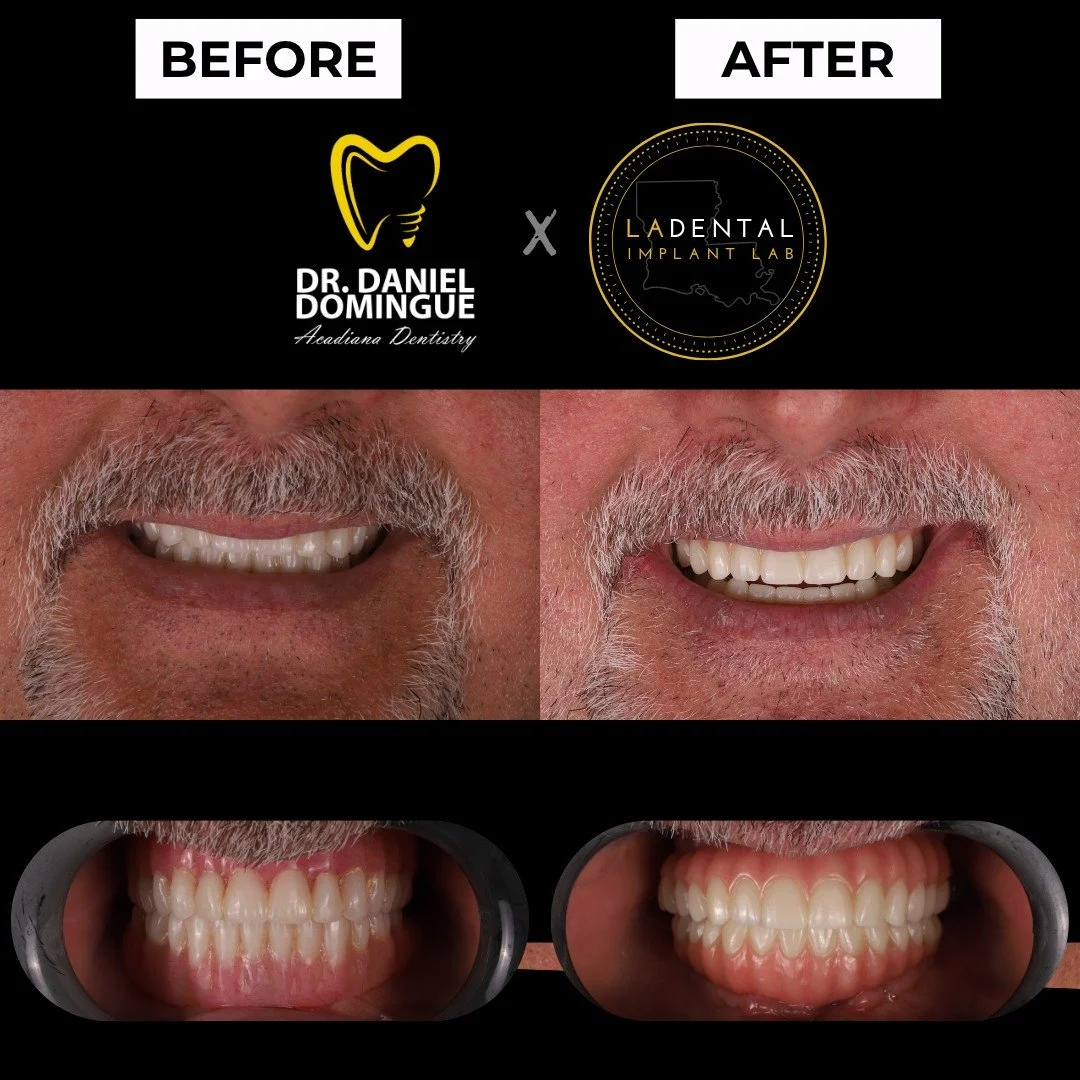 This case began with an implant-supported overdenture, 4 implants in the maxilla and 3 in the mandible. While functional, the patient was seeking improved stability, comfort, and long-term predictability.

Treatment included the strategic placement o
