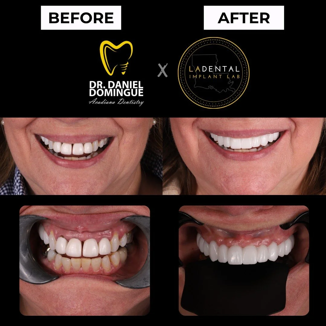 This patient presented with significant concerns in the upper anterior region, specifically teeth #7&ndash;10, where bone loss and mobility were evident. Additionally, occlusal interference from the lower anterior teeth contributed to ongoing periodo