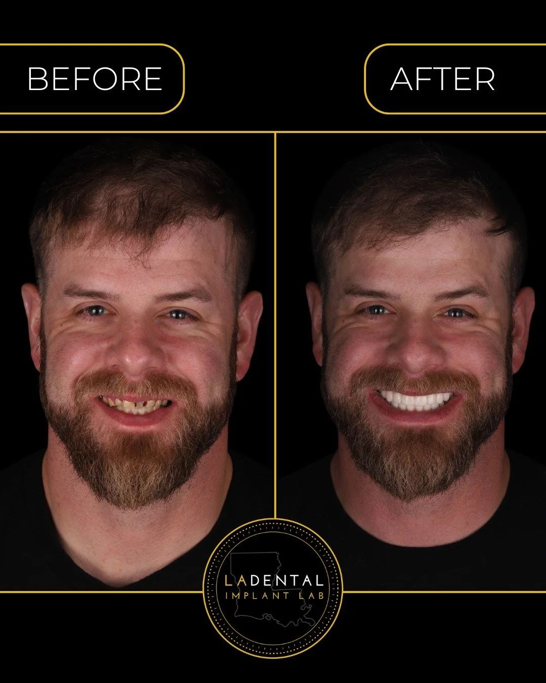 Every before-and-after case tells a story of planning, execution, and precision.

At LA Dental Implant Lab, we work alongside clinicians to transform complex cases into predictable outcomes, whether it&rsquo;s full-arch rehabilitation, custom abutmen